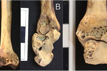 Вчені знайшли в Нубії кістяк жінки, яка страждала на ревматоїдний артрит: один з перших прикладів захворювання 