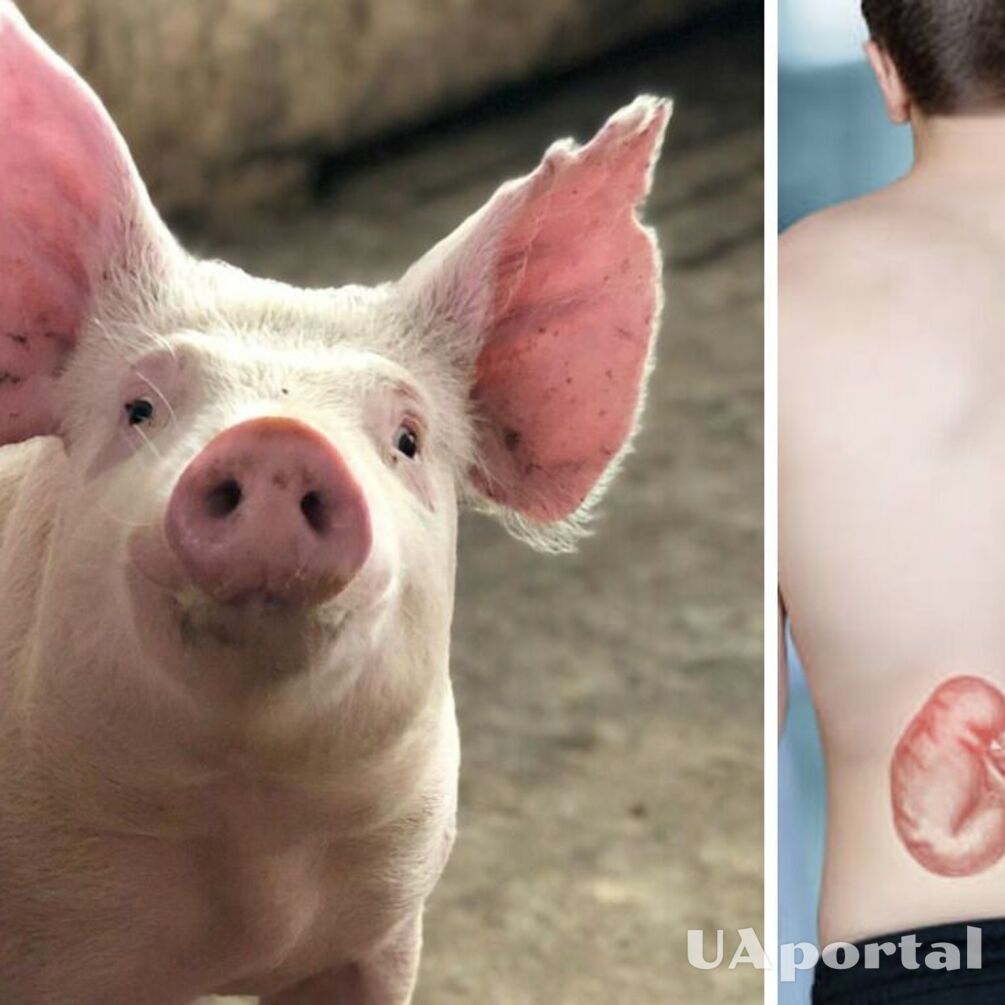 For the first time in the world: genetically modified pig kidney transplanted into a human