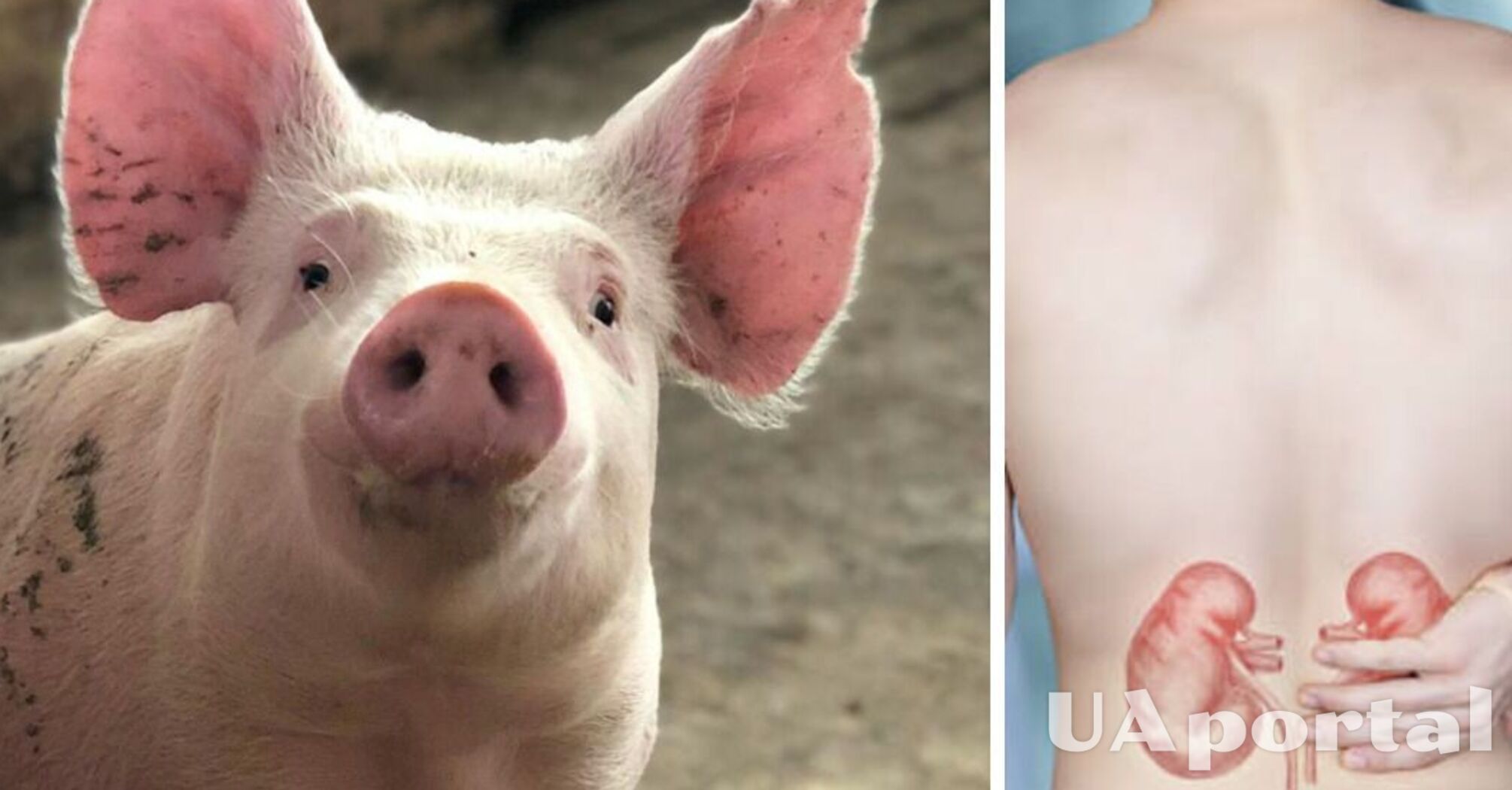 For the first time in the world: genetically modified pig kidney transplanted into a human