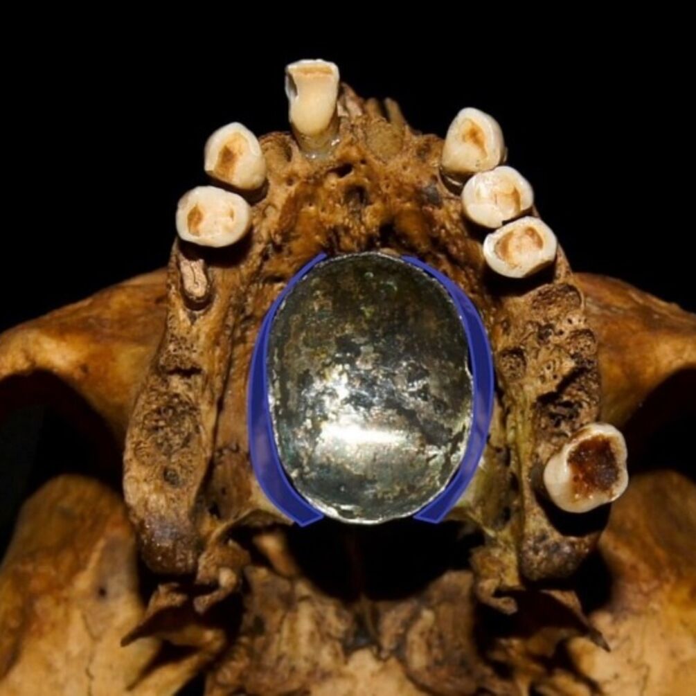 W Polsce odnaleziono unikalną 300-letnią protezę (zdjęcie)
