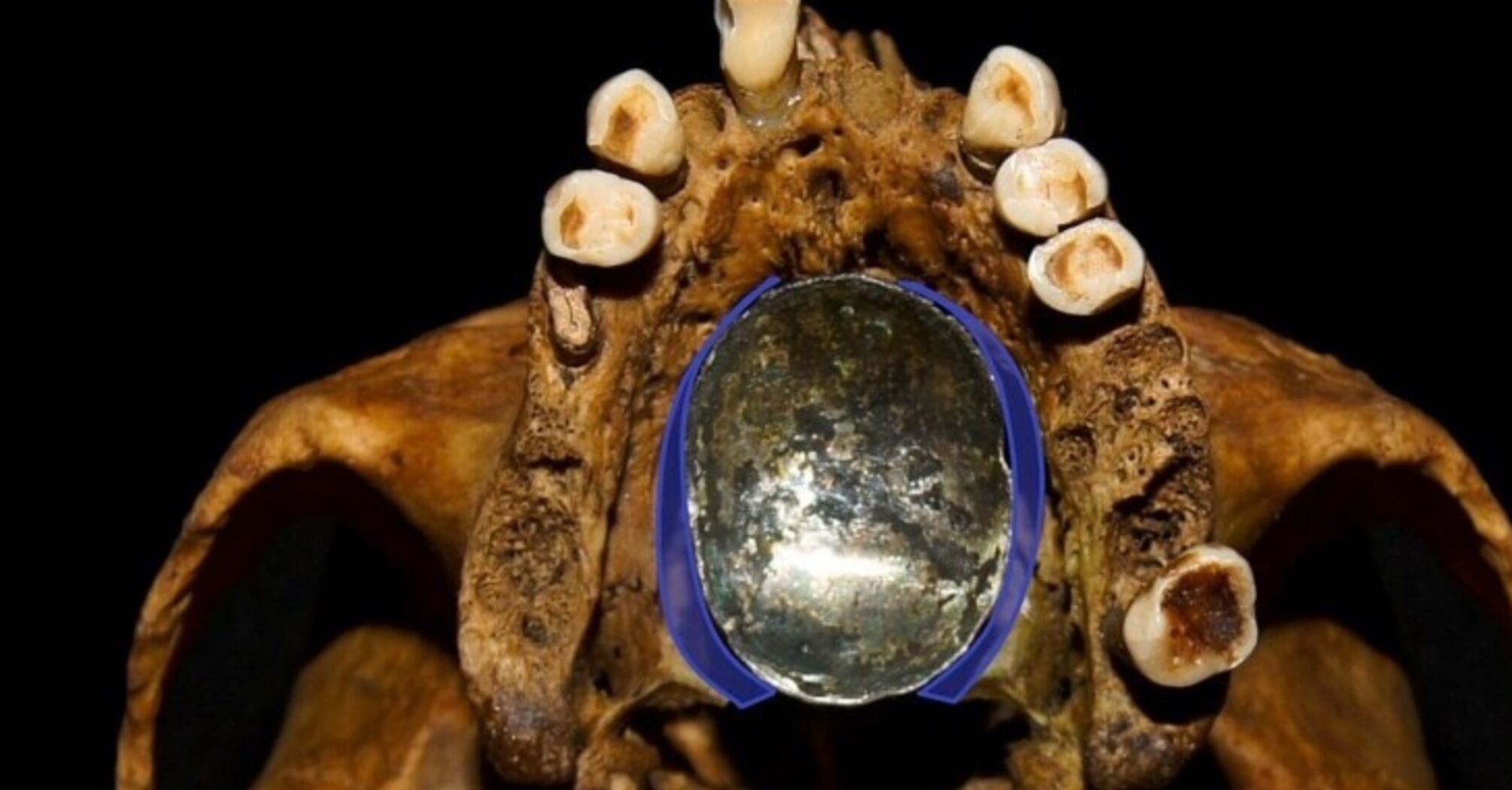 W Polsce odnaleziono unikalną 300-letnią protezę (zdjęcie)