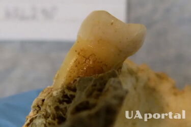 Scientists have found bacteria that cause tooth decay in 4,000-year-old teeth