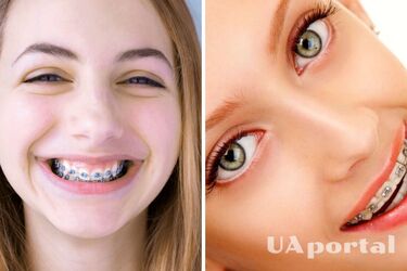 Какие продукты можно и нельзя есть с брекетами: советы стоматологов