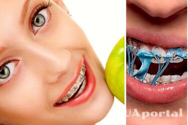 Какая еда может повредить брекеты