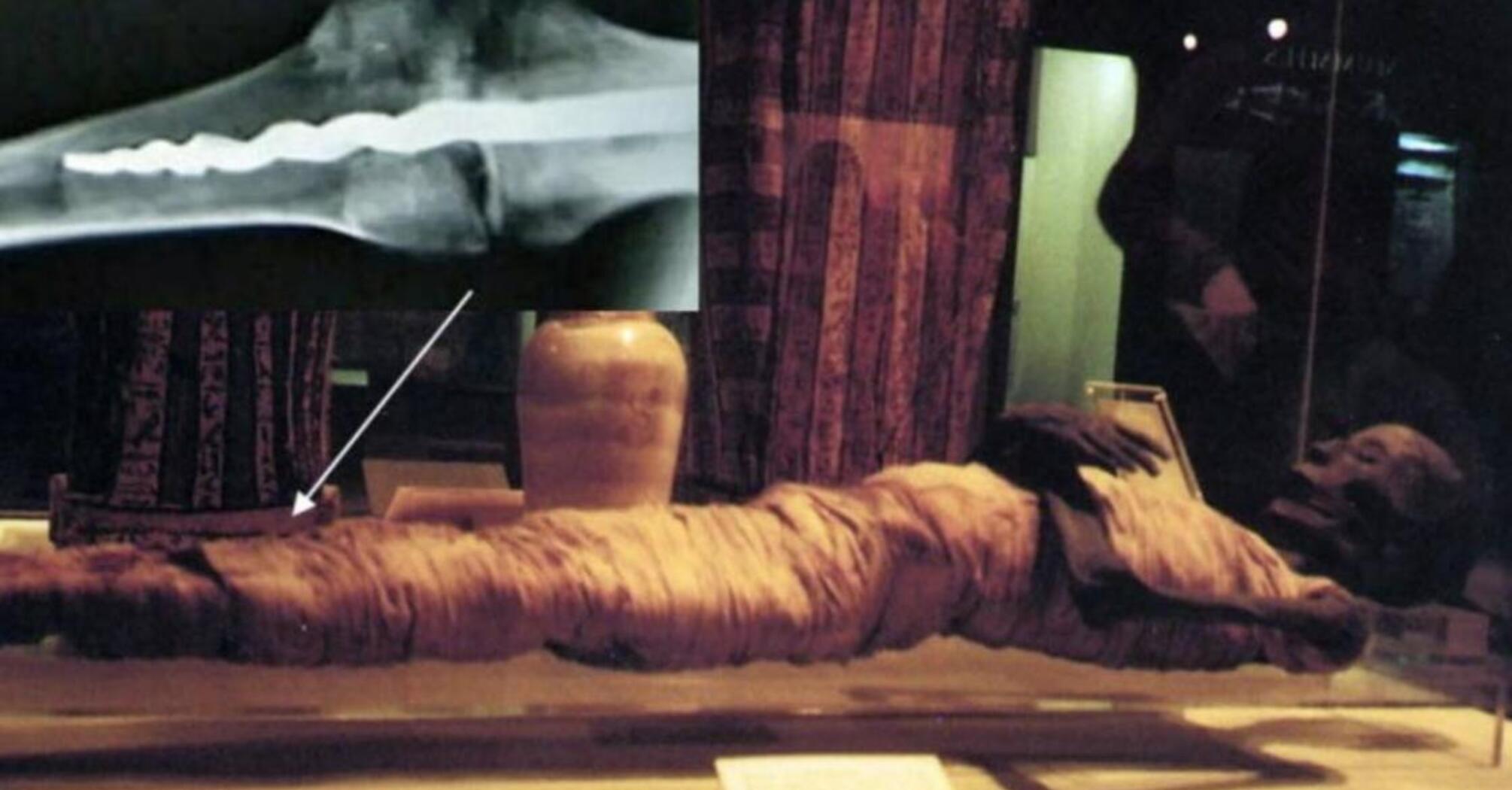 Металлический секрет древней мумии: ученые обнаружили имплант, которому около 2600 лет