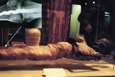 Металевий секрет стародавньої мумії: вчені виявили імплант, якому близько 2600 років