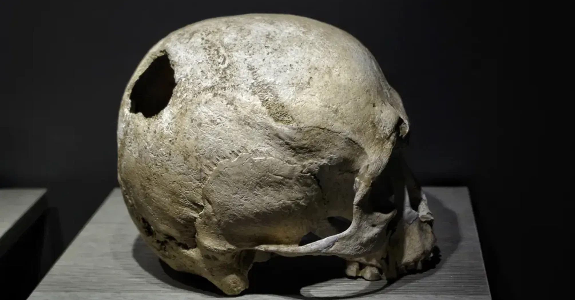 Европейцы времен неолита ходили с дырками в черепах: ученые объяснили, почему