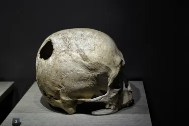 Європейці часів неоліту ходили з дірками в черепах: науковці пояснили, чому