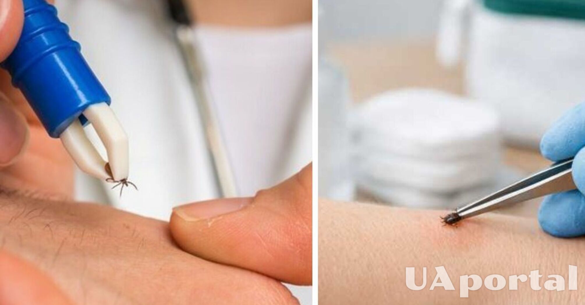 Вкусив кліщ: лікар порадив, як правильно його видалити   